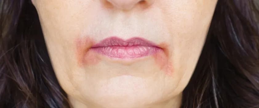 Zapalenie Wokół Ust: Zrozum Dermatozę Okołoustną, Zdjęcia i Leczenie Zapalenia Skóry