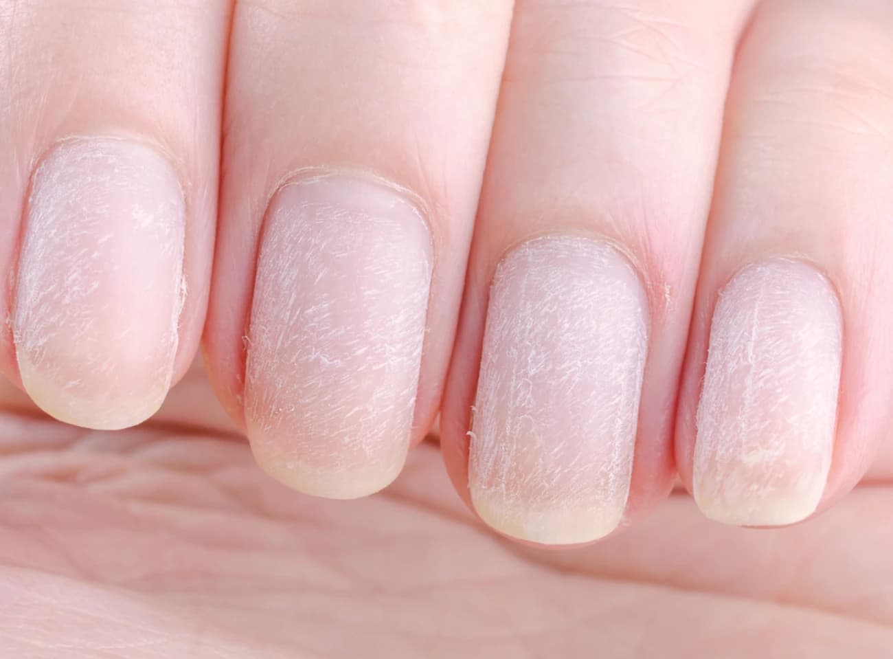 Uszkodzona macierz paznokcia: objawy, leczenie, regeneracja